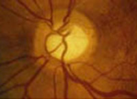 Ph.2 : Nerf optique glaumatique