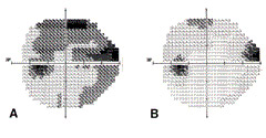 Ph.2 : des champs optiques glaumatiques